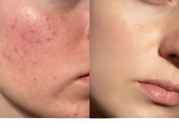 PELE COM ACNE